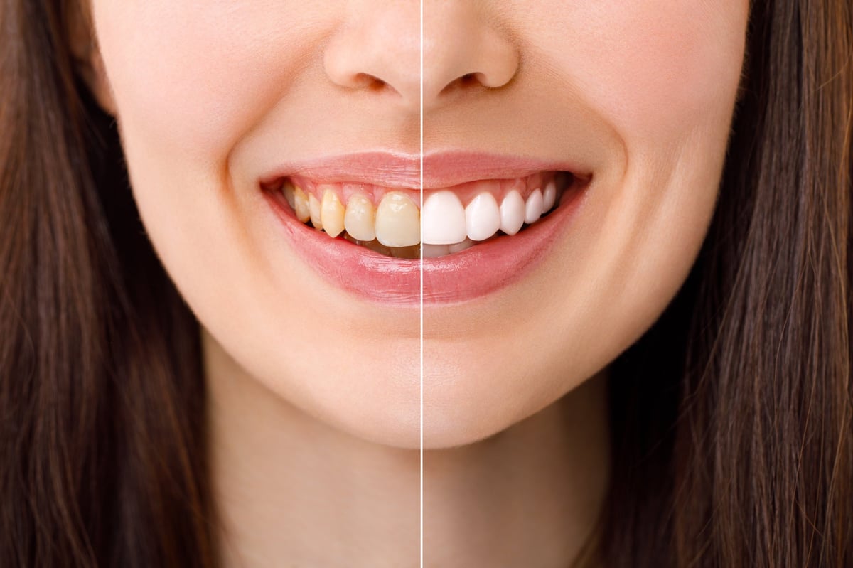 Smiling woman before and after teeth whitening