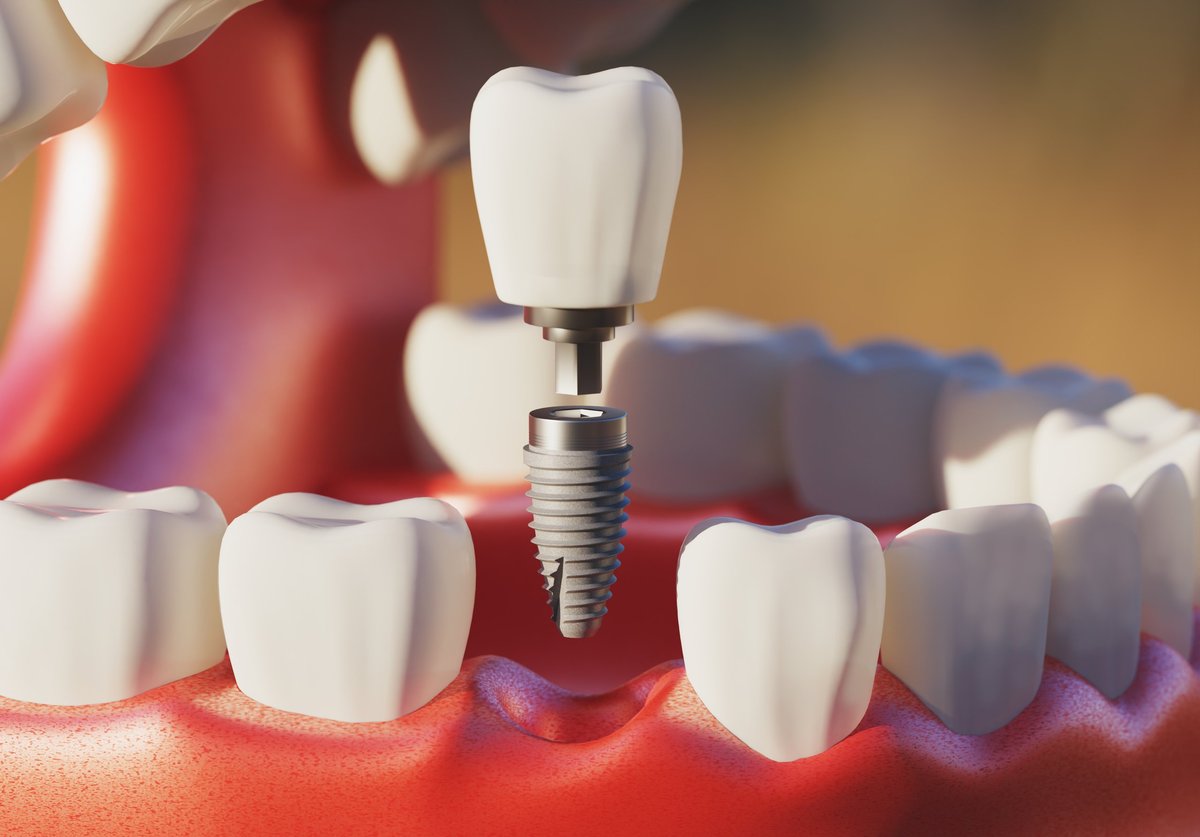 Dental implant screw placement procedure