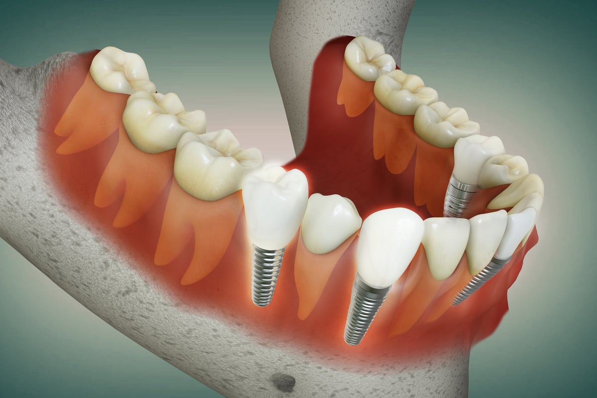 Multiple teeth dental implant
