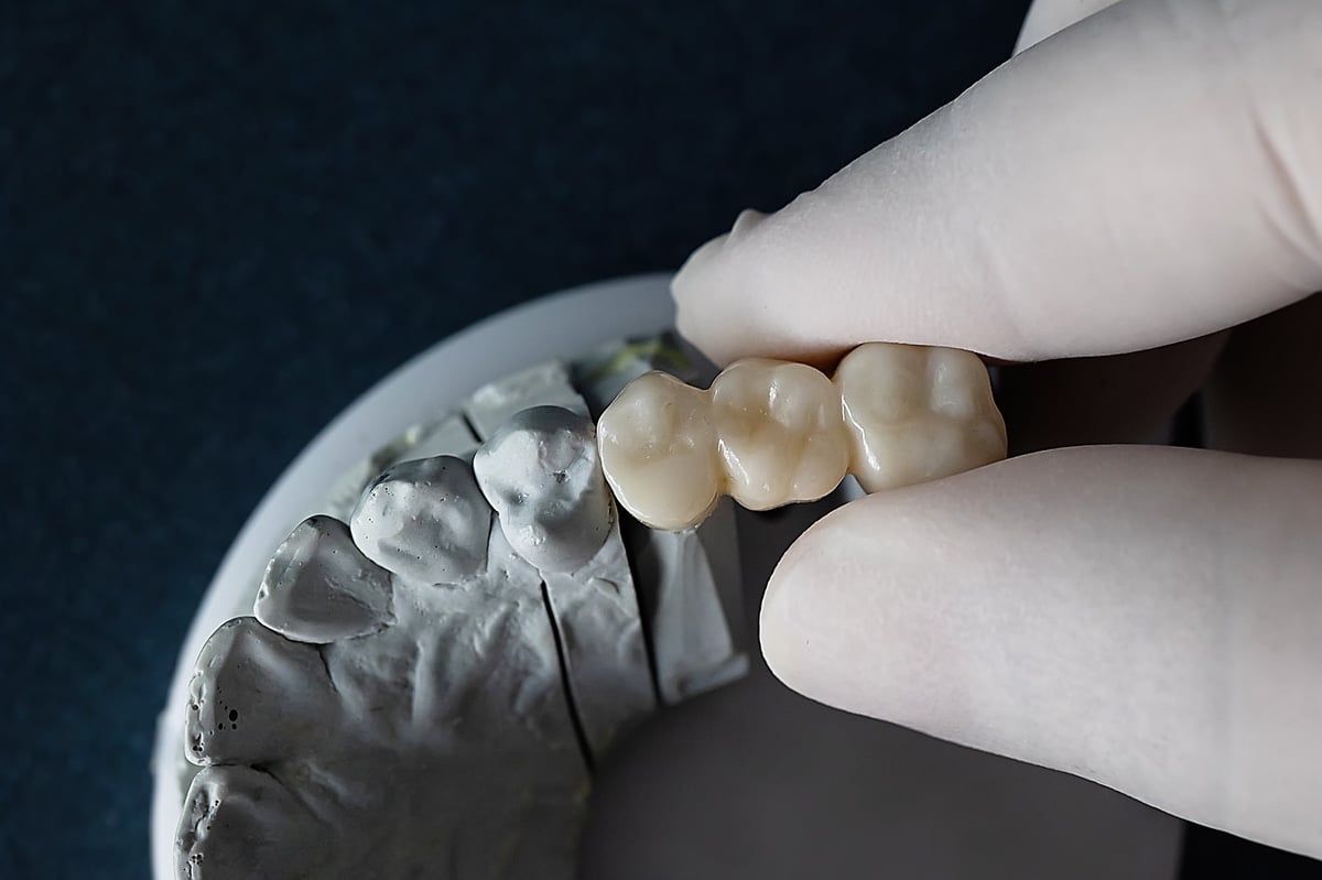 Dental bridge and prosthetics lab work