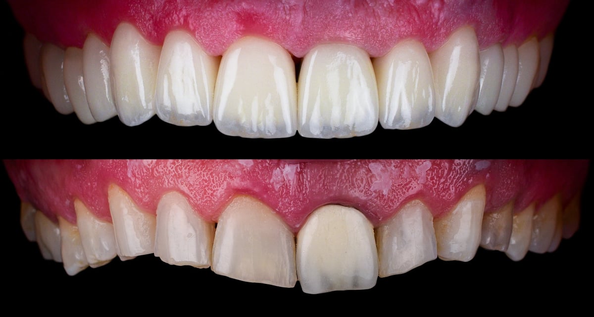 Ceramic crowns and veneers